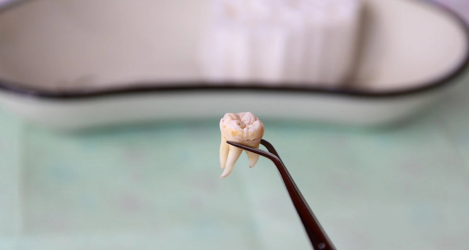 Irrigating Wisdom Tooth Socket 5 Detailed Complications