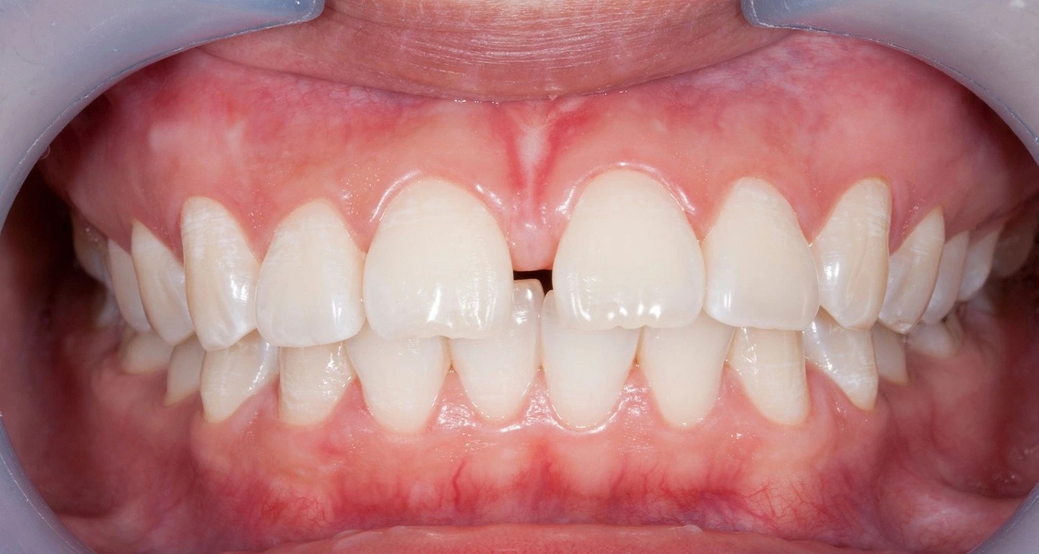 Gap Between The Teeth (Diastema) 3 Important Reasons