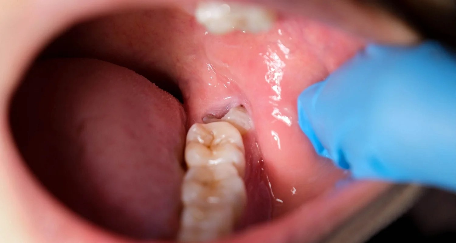 Removing Food Stuck in Wisdom Tooth Hole (5 Effective Ways)
