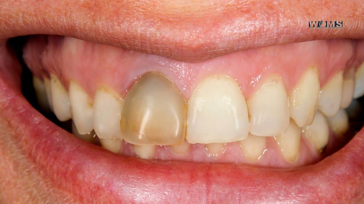 Dead Tooth How to Prevent it? WOMS