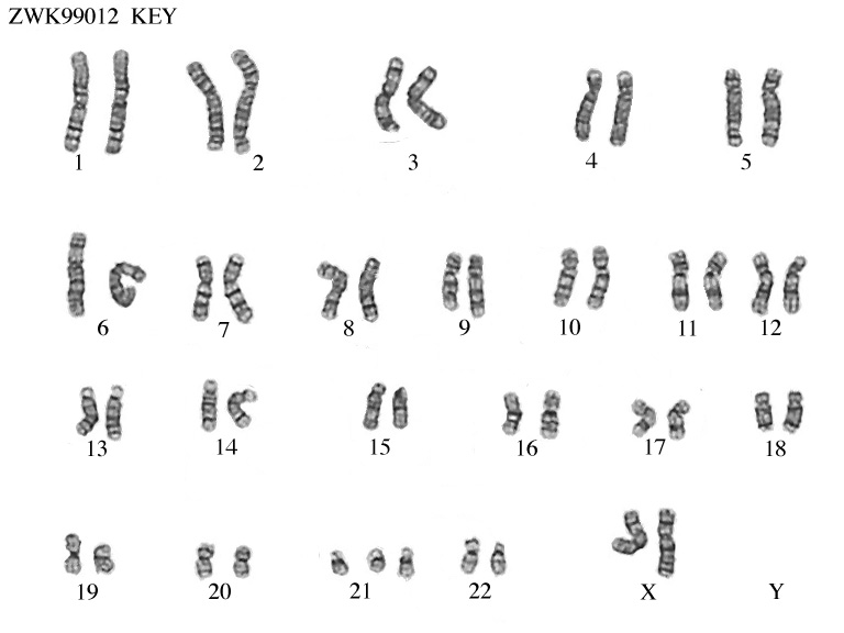 Zooweb Karyotypes 47 Xy 21