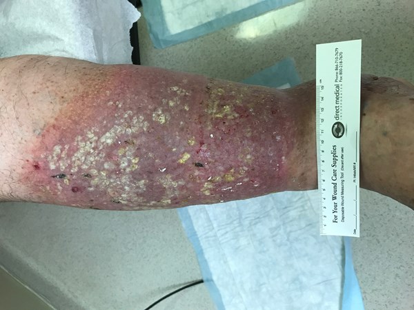 Venous ulcers WoundReference