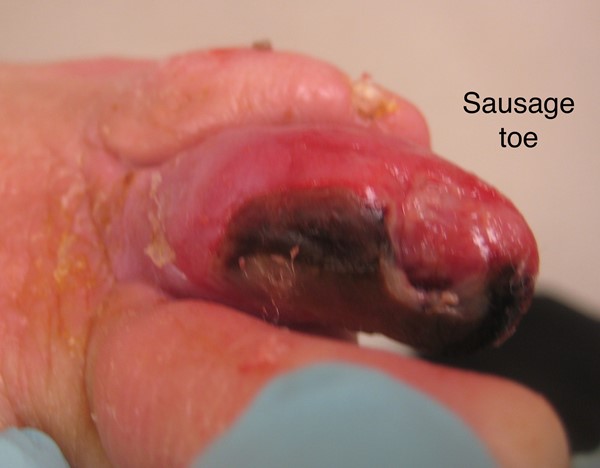 Diabetic Foot Ulcers Classification Systems