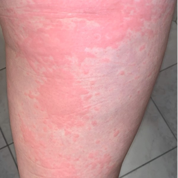 Cutaneous Manifestations Associated With COVID19