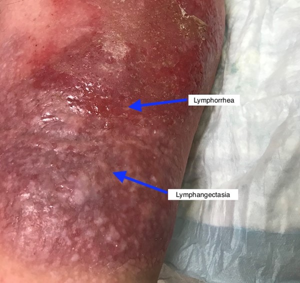 Lymphedema Introduction and Assessment