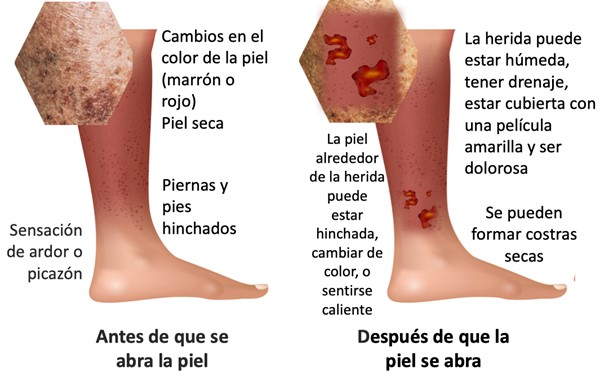 Patient Education Venous Leg Ulcers (Spanish)