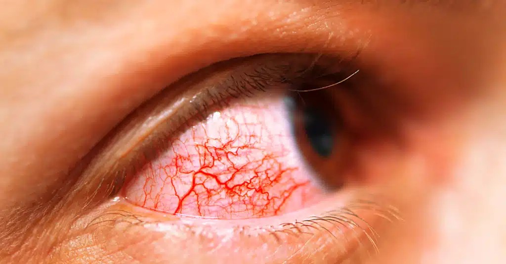 Is Pink Eye Contagious? Understanding the Risks and Prevention