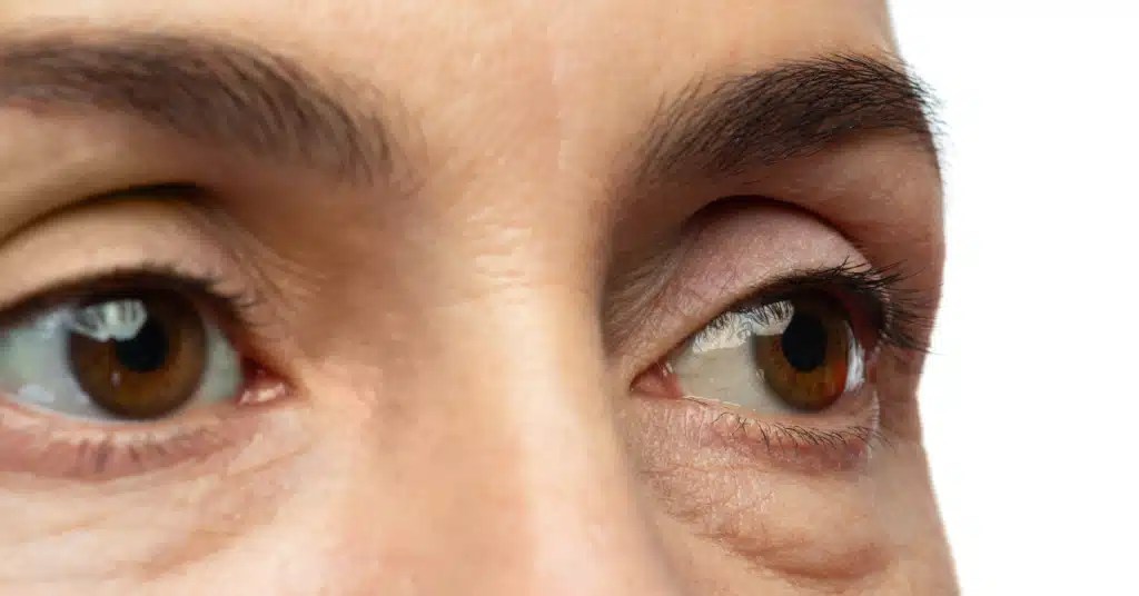 What Causes Bags Under Eyes Find Out Reasons