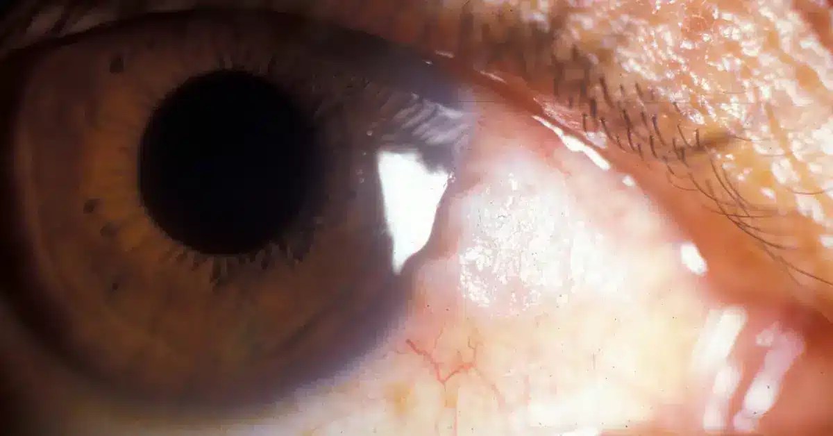 Can Dehydration Cause Eye Floaters? All you Need to Know