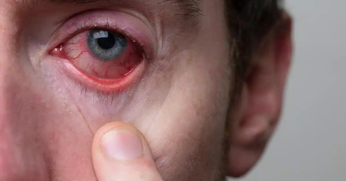 Is Pink Eye Contagious? Understanding the Risks and Prevention
