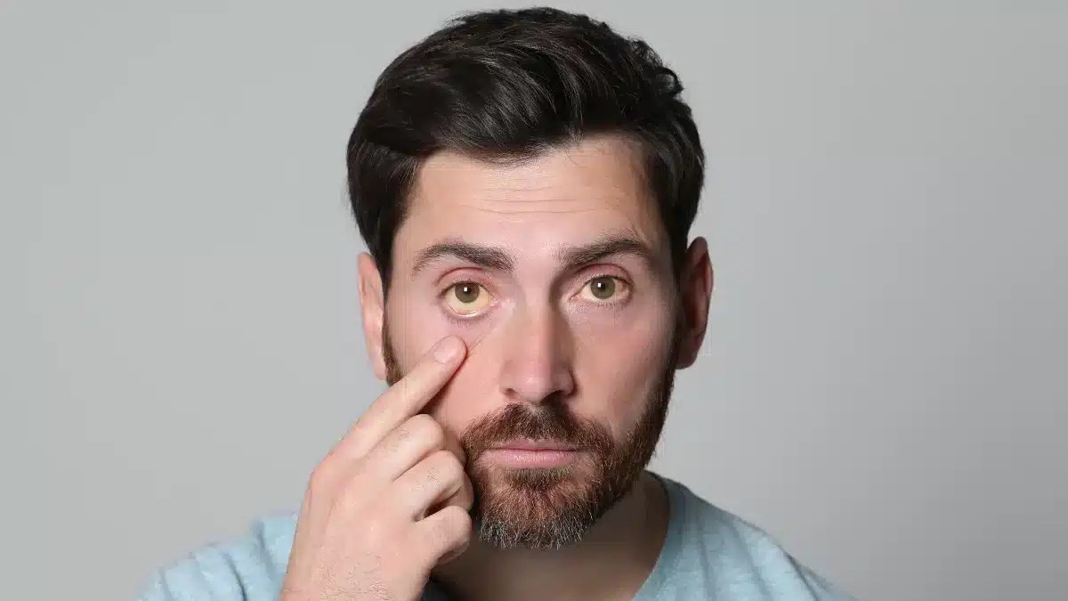 Understanding Gonococcal Conjunctivitis Gonorrhea in Eye