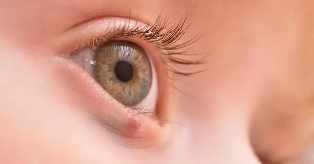 Why is My Eyelid Swollen? A Look at the Possible Causes