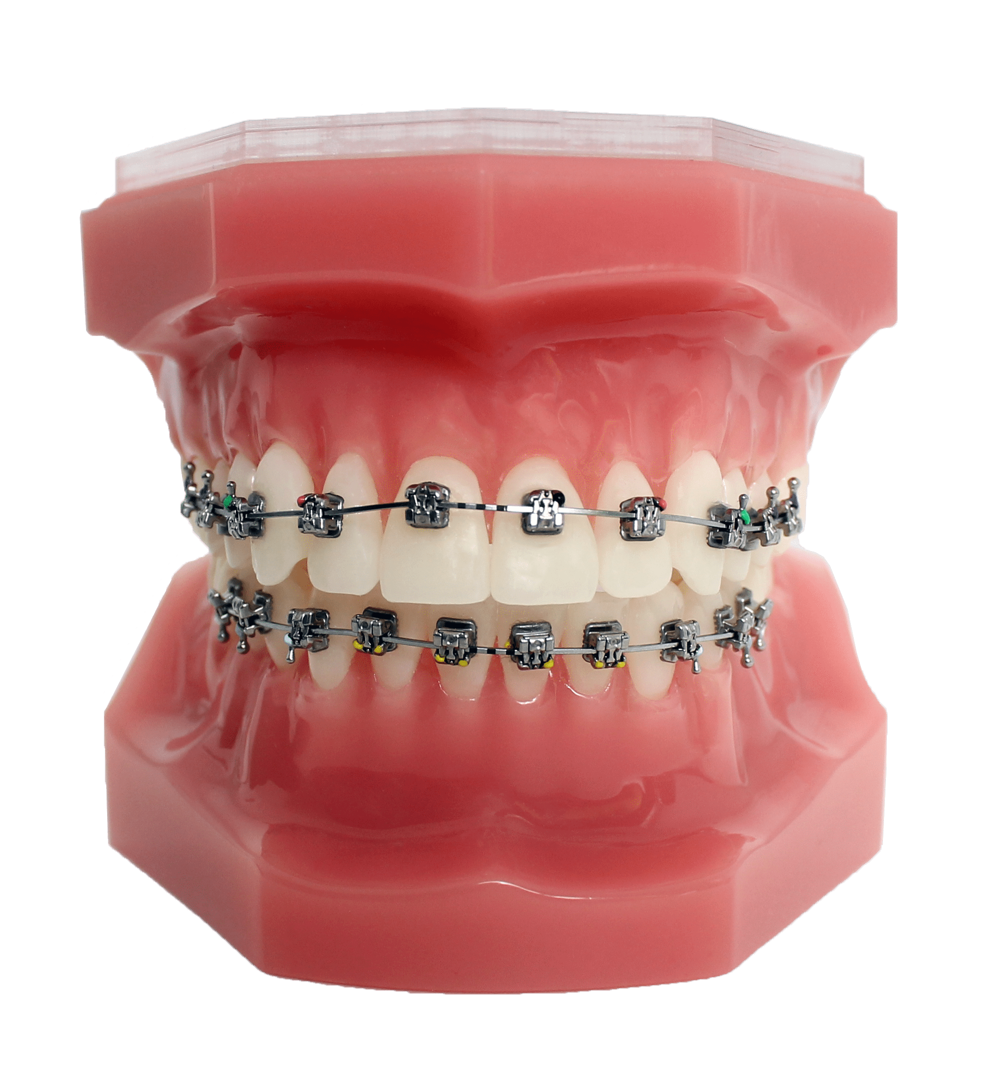 Ukiah Braces Braces Ukiah Affordable Braces Ukiah