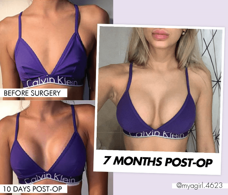 best breast augmentation surgeons london Jong Wilke