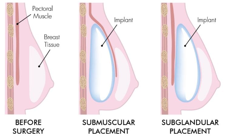 Do over the muscle implants look bigger?