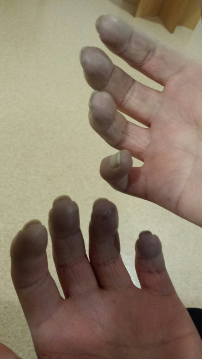 Raynaud’s Why Glasgow nurse felt like cutting off top of