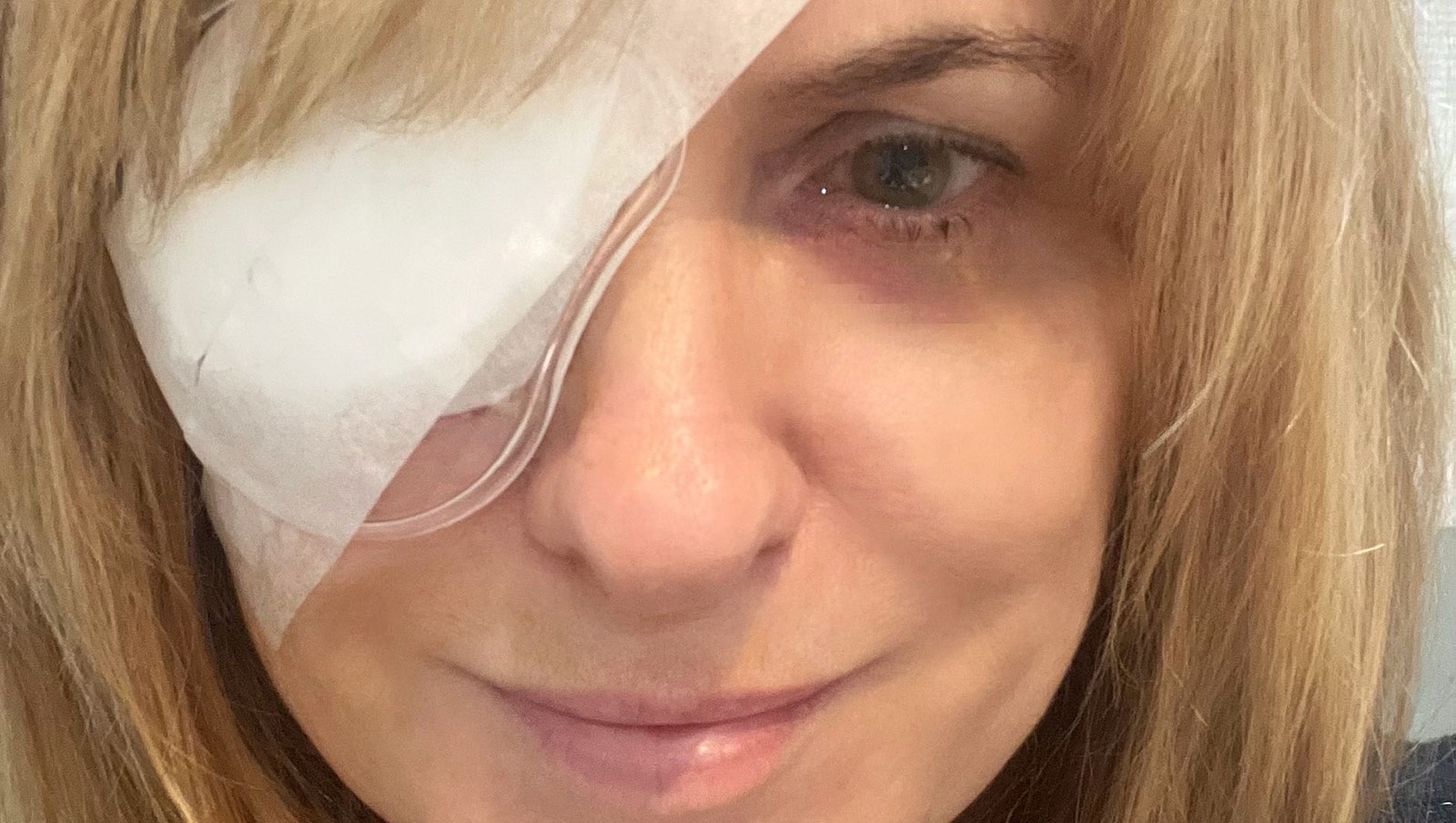 Bilateral Cataract Extraction & Intraocular Lens Implant Write of the