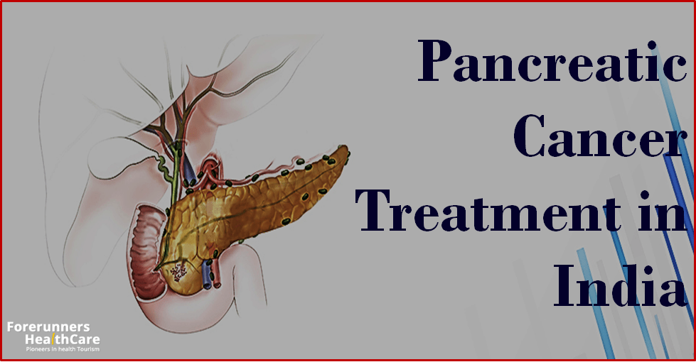 Plan your Pancreatic Cancer Treatment in.. WritersCafe
