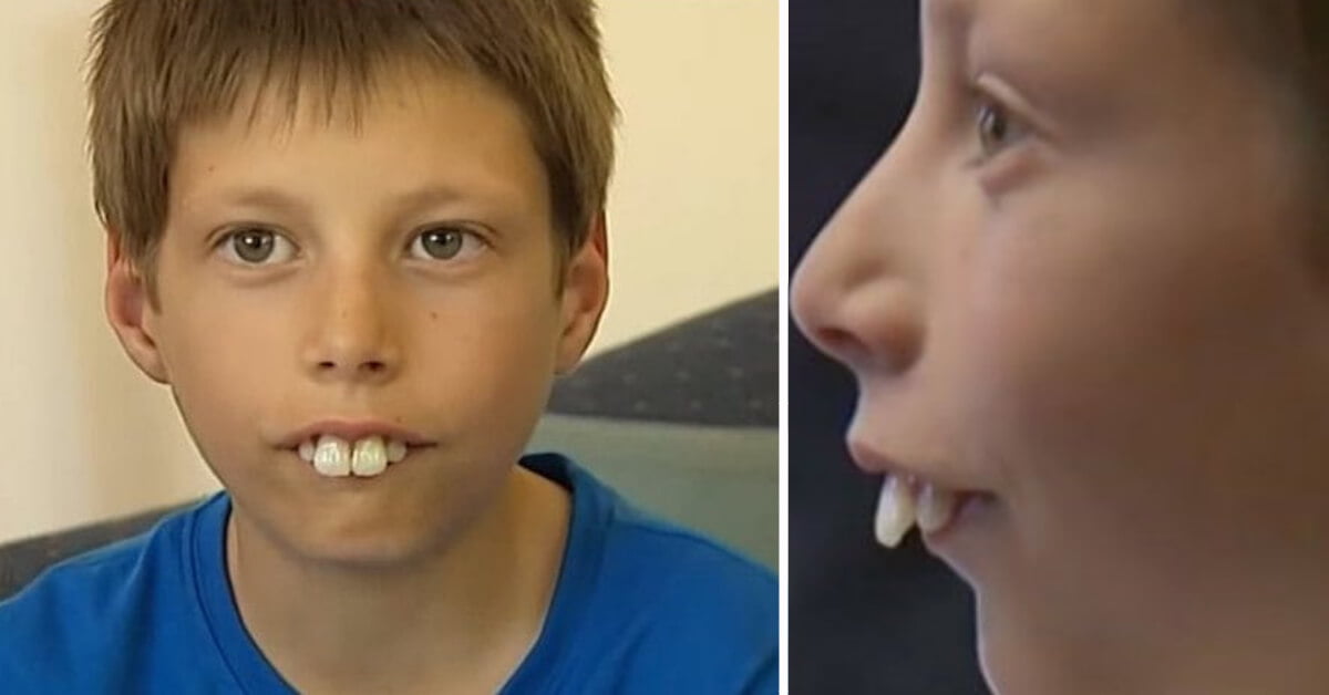 Kid bullied for his teeth problem, now has a new smile. Writical