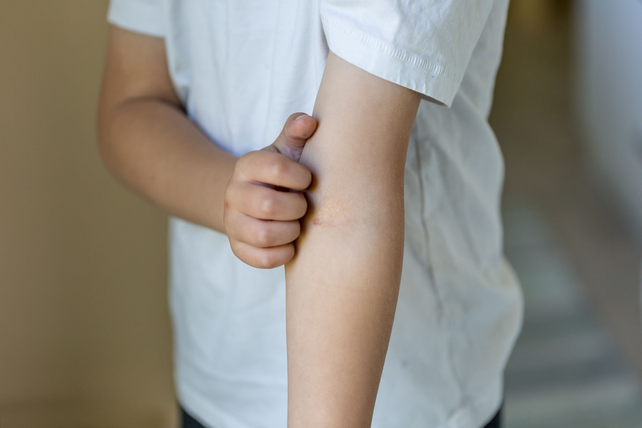 Eczema in kids What parents can do to calm the itch WTOP News