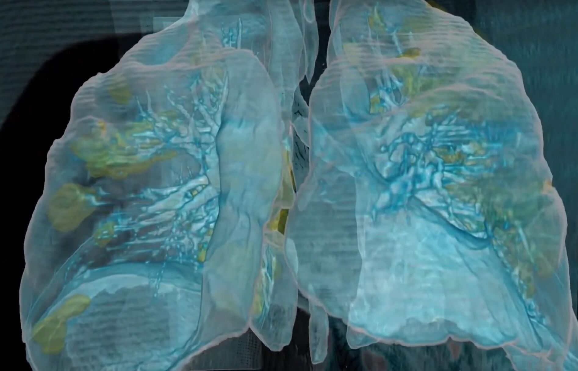 Coronavirus Virtual reality helps GW Hospital see inside