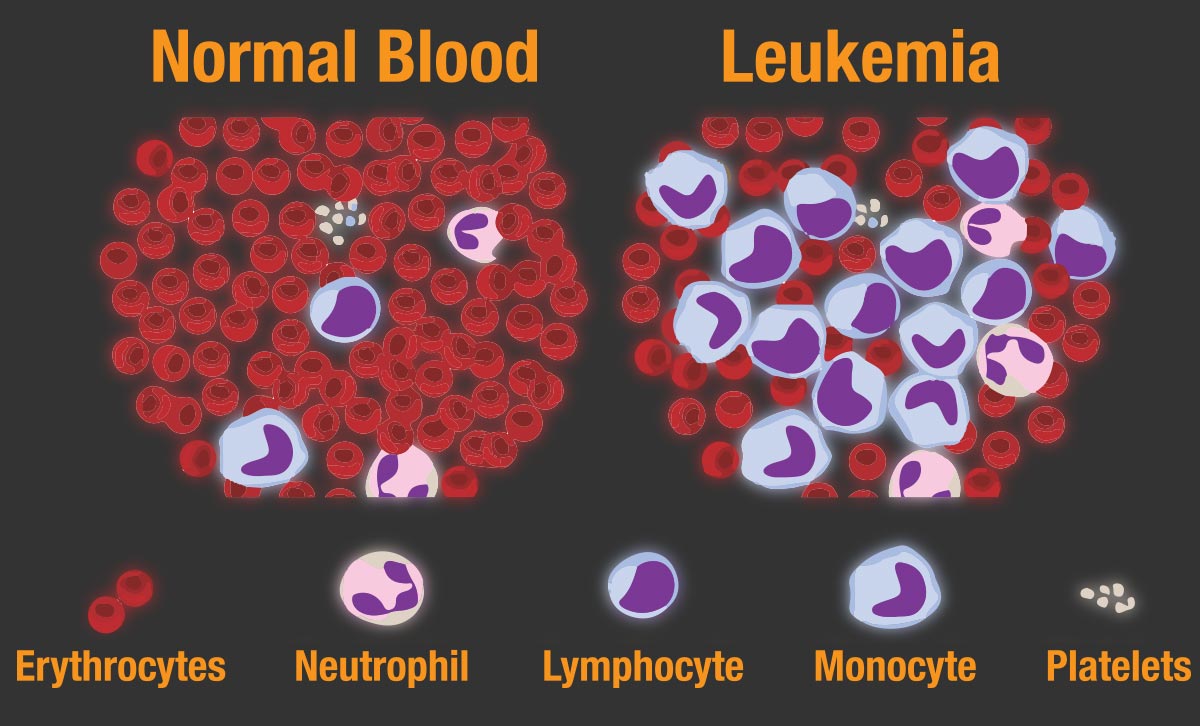 Lymphatic & Blood Cancer Facts & Symptoms UHC Oncology