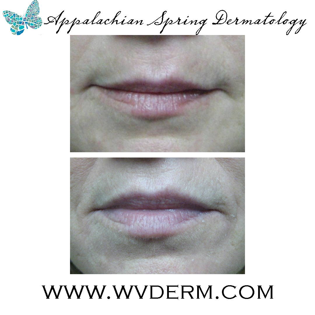 Comparing Fillers – Appalachian Spring Dermatology