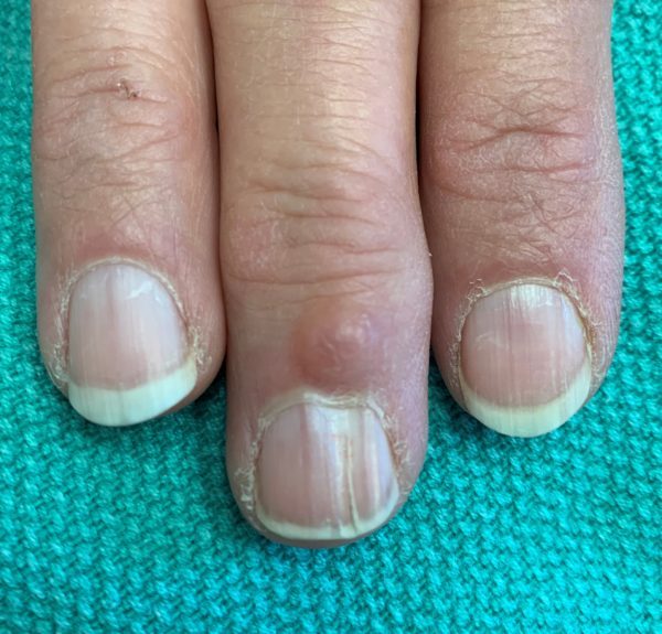 What is this Bump on my Finger? Digital Mucous Cyst Appalachian