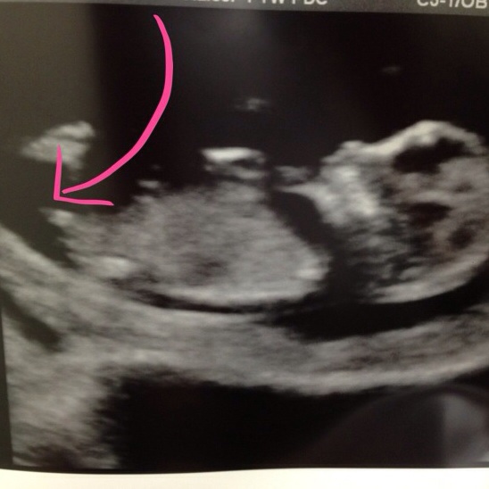 NUB Theory 12 weeks….. boy or girl?? !!! (just for fun)