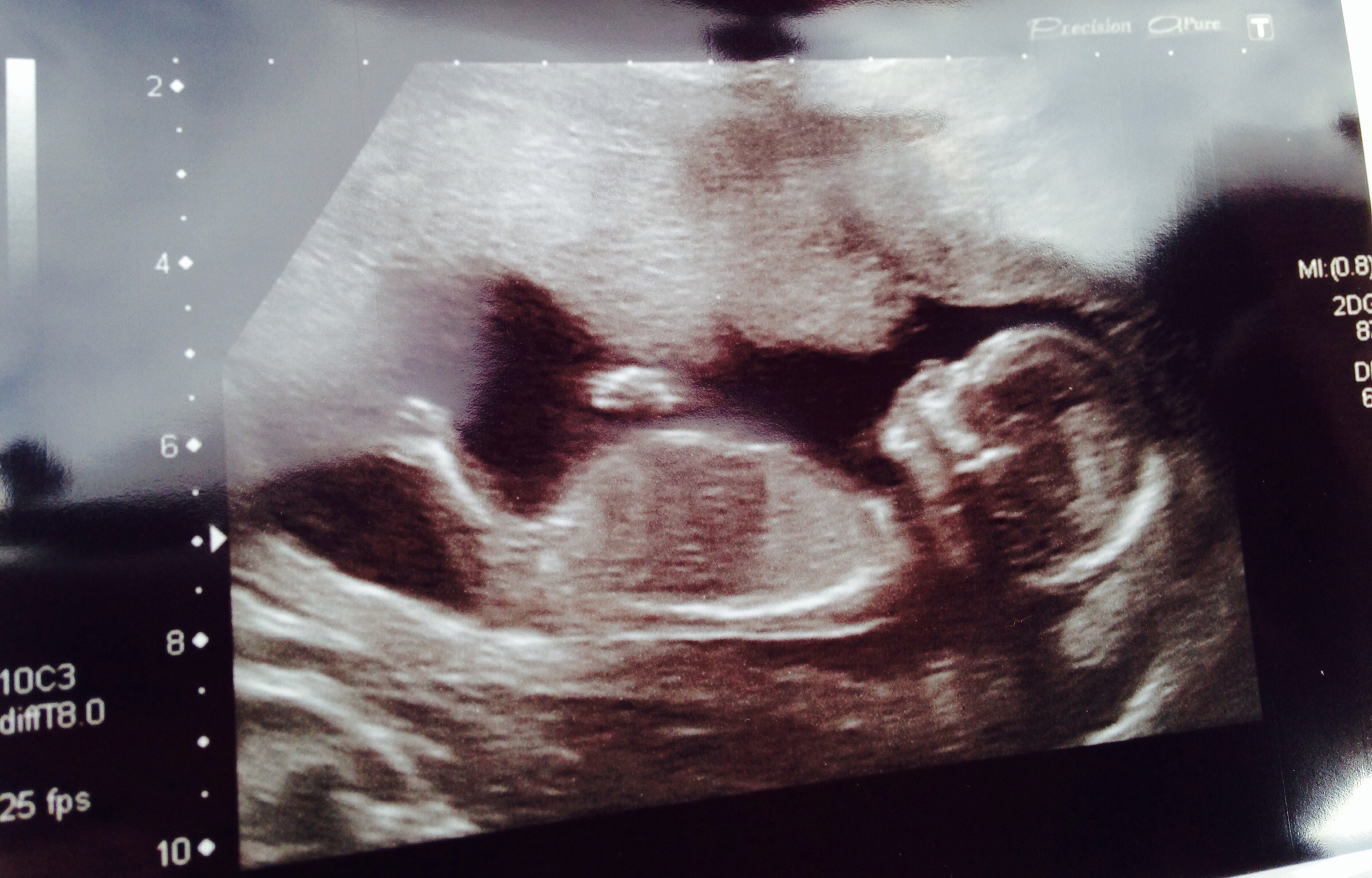 First ultrasound scan