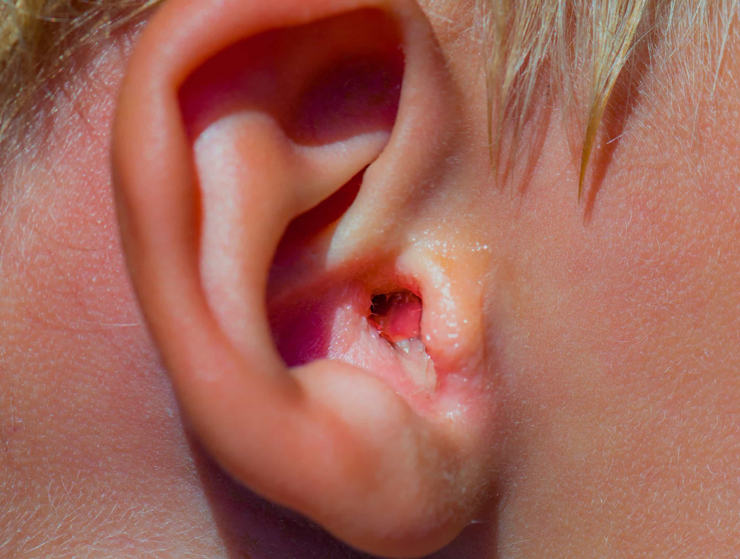Swimmers Ear (Otitis Externa) Causes, Diagnosis & Treatment 150