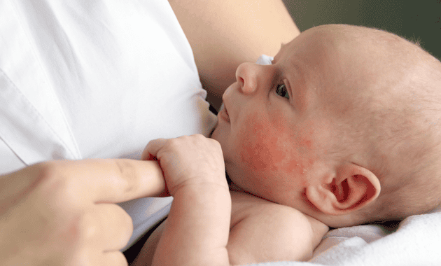 5 Common Skin Problems In Kids + Tips That Can Help 1mg Capsules