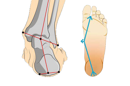 over pronation feet
