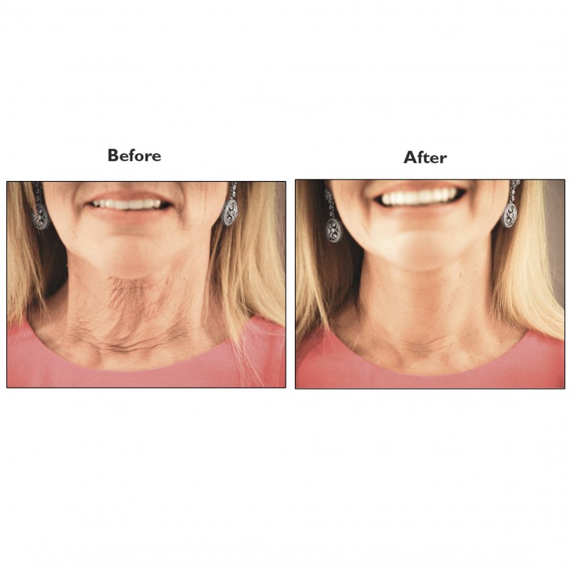 How To Reduce Double Chin With A Tape 365