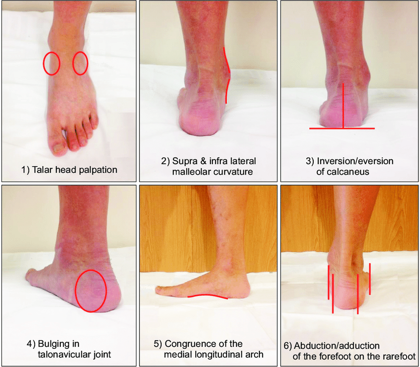 Problems with flat feet? This exercise might help
