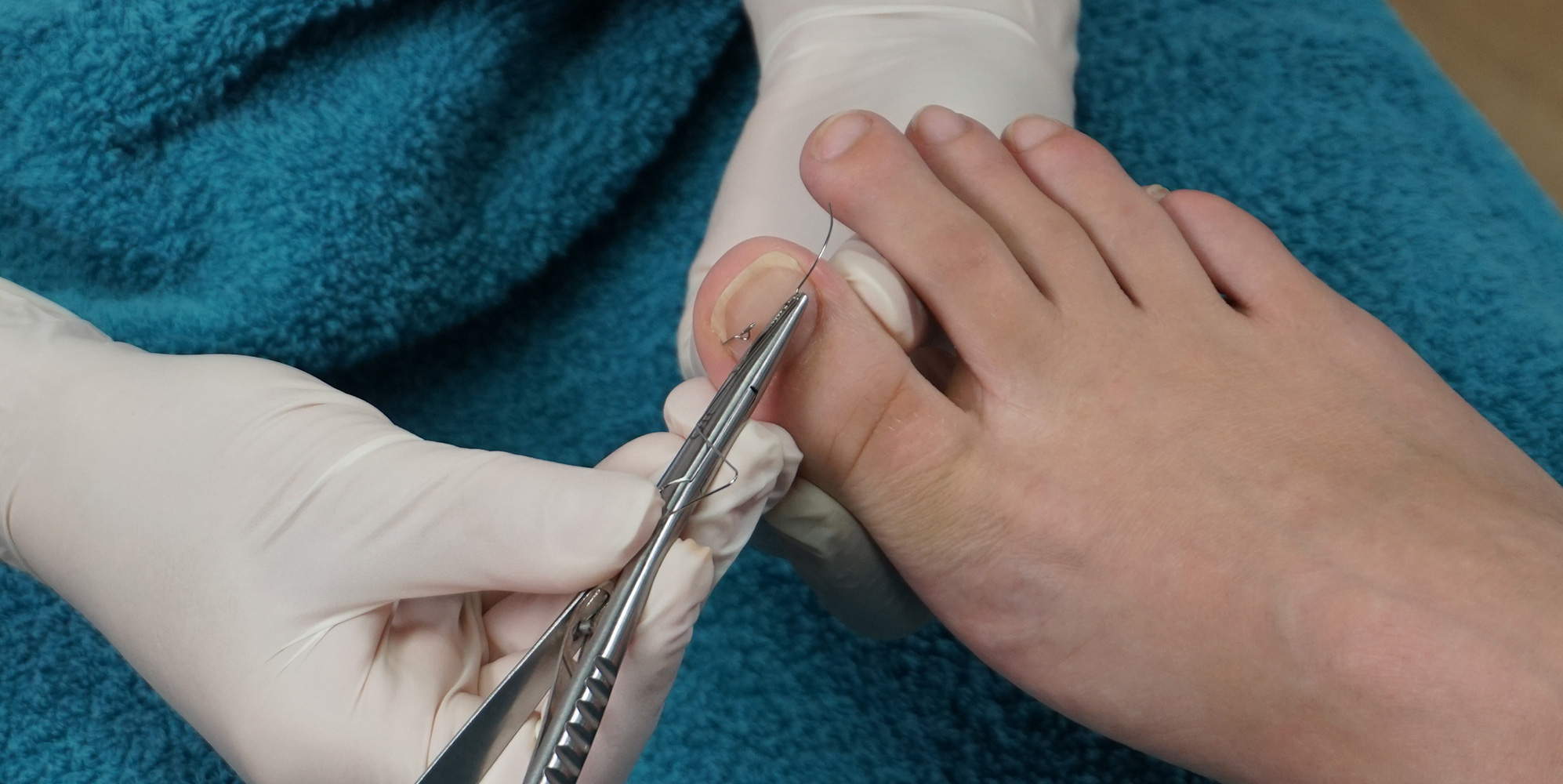 Treatment of ingrown toenails with the 3TO brace 3TO Ihr Spezialist