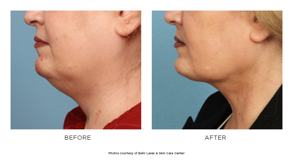 Liposuction Before & After Photos Behr Laser & Skin Care Center