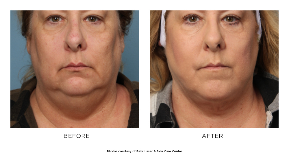 Liposuction Before & After Photos Behr Laser & Skin Care Center