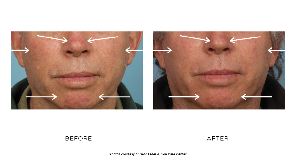 Vbeam Prima Before & After Photos Behr Laser & Skin Care Center