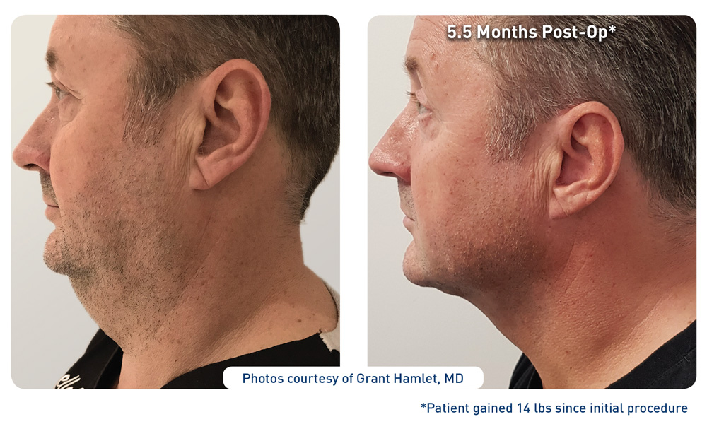 Renuvion Before & After Photos Behr Laser & Skin Care Center