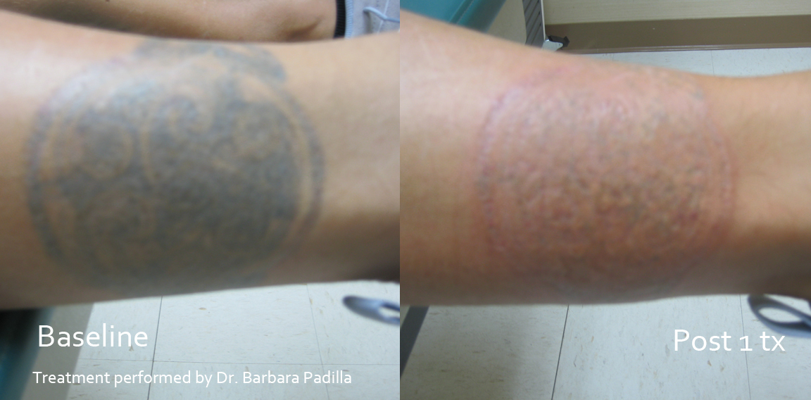 Laser Tattoo Removal Second Treatment home tattoo removal salt