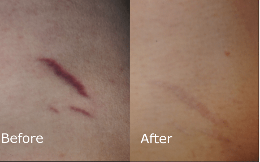 Laser Genesis Cutera Excel V Hartford CTLaser Genesis Cutera