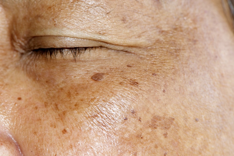 How to Treat Hyperpigmentation, Dark Spots & Uneven Skin Tone A