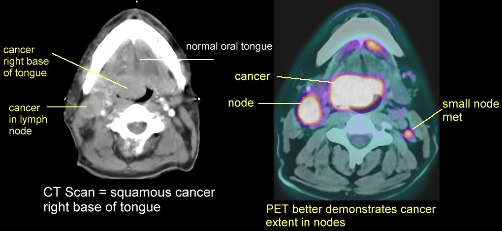 PET and CT Scans