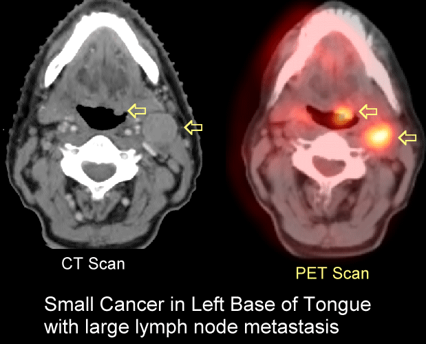 PET and CT Scans