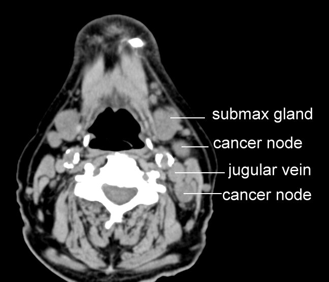 PET and CT Scans
