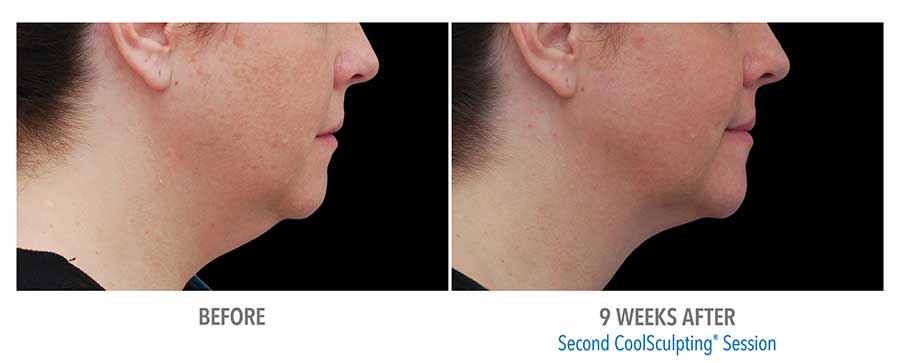 Before and After in Snellville, GA About Face Skin Care