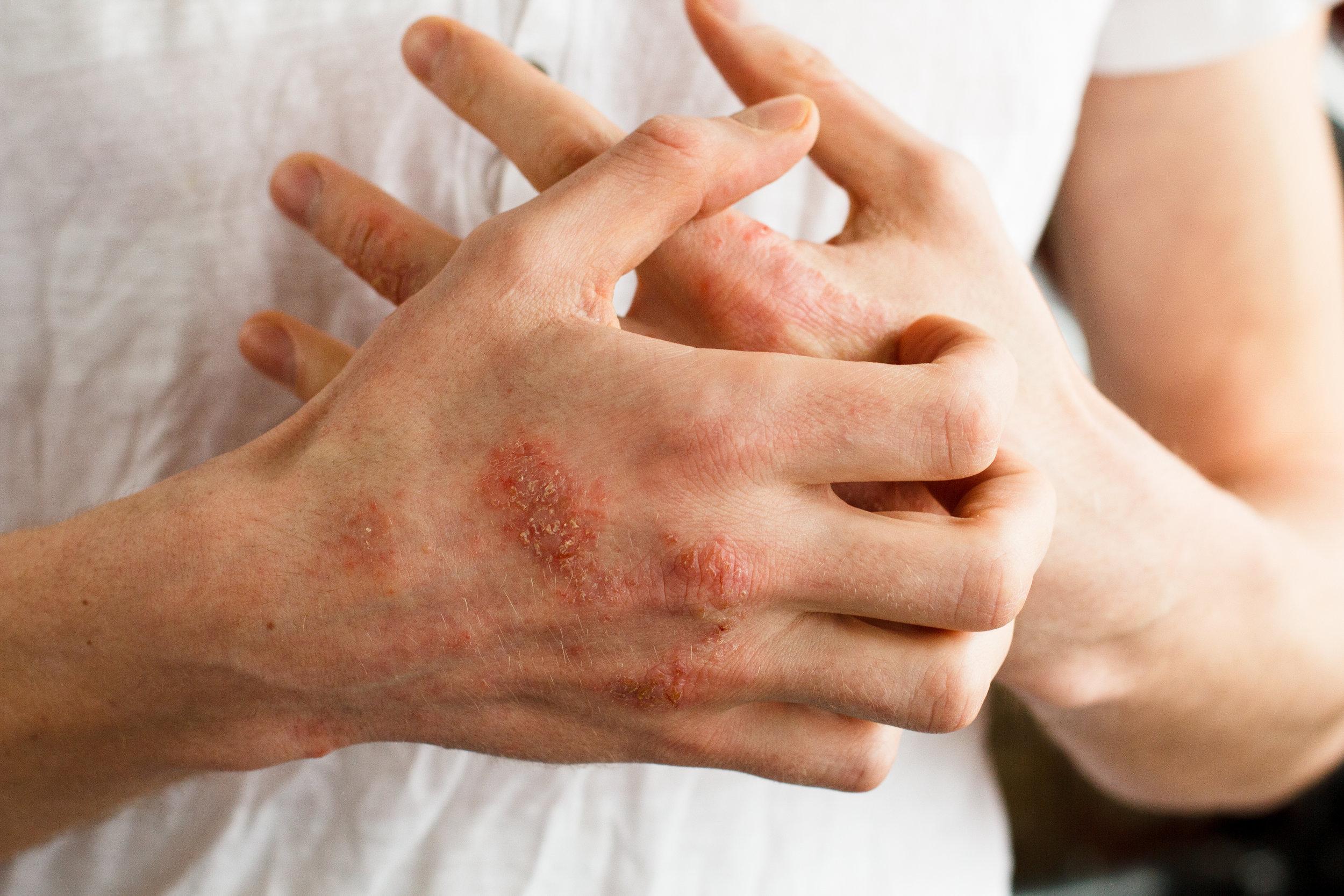 Atopic Dermatitis Causes, Symptoms & Treatment Options Academic