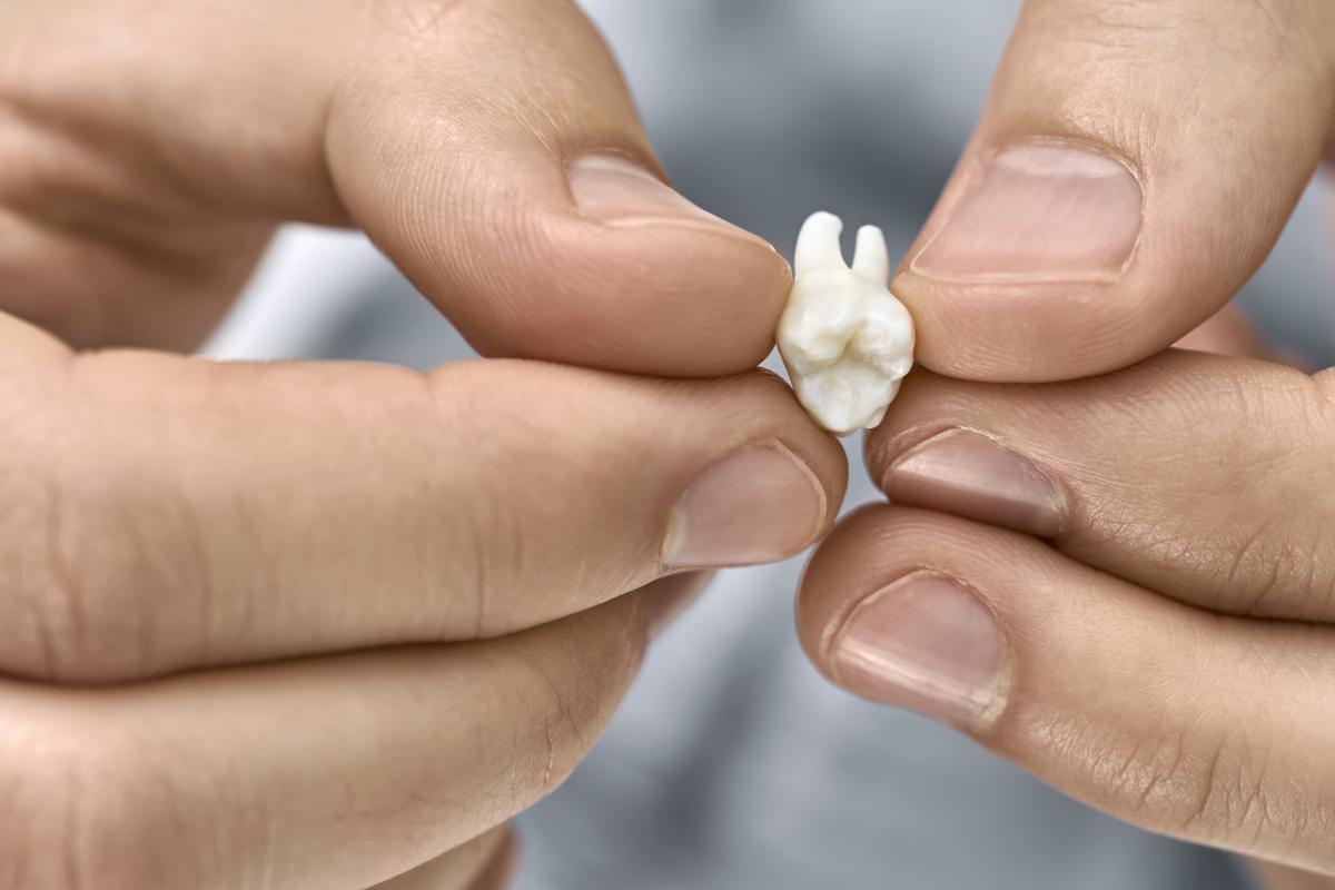 Treating an Avulsed Tooth Dental Trauma Treatment