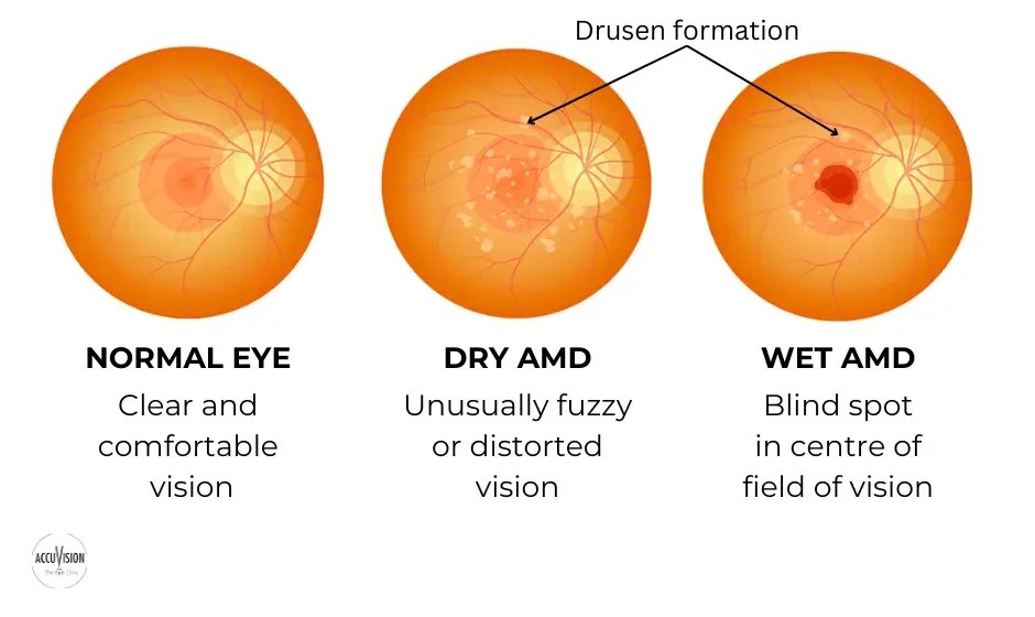 AgeRelated Macular Degeneration Causes, Symptoms and Treatment